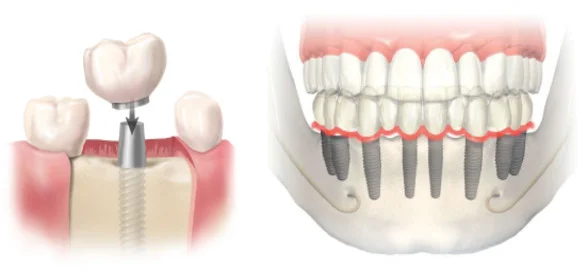 multident-tratamiento-implantes-dentales-5